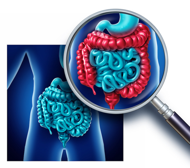 Graphic representing bowel and colon pain or inflammation