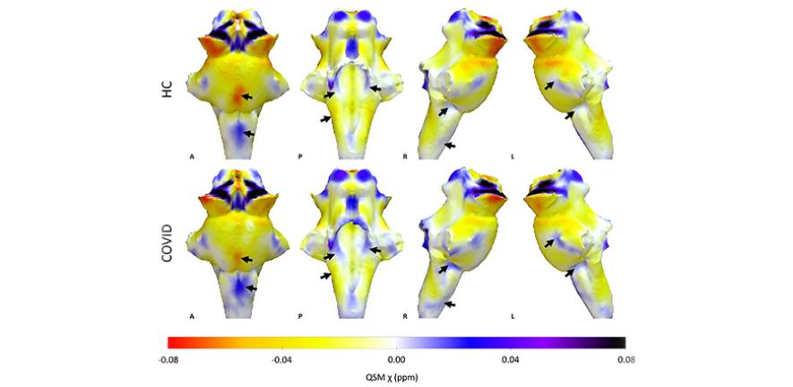 3D projections of QSM maps on the rendered brainstem  Credit: University of Cambridge
